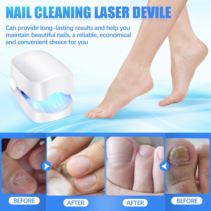 12915 Rechargeable Nail Fungus Treatment For Toenail Toe Nail Fungal Treatment Nail Fungus Laser Device Anti-fungal Nail Treatment For Hand  Feet Infections Remover For Home Use - Trendex